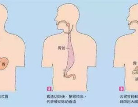 食管癌治疗,食管癌治疗策略与进展概述